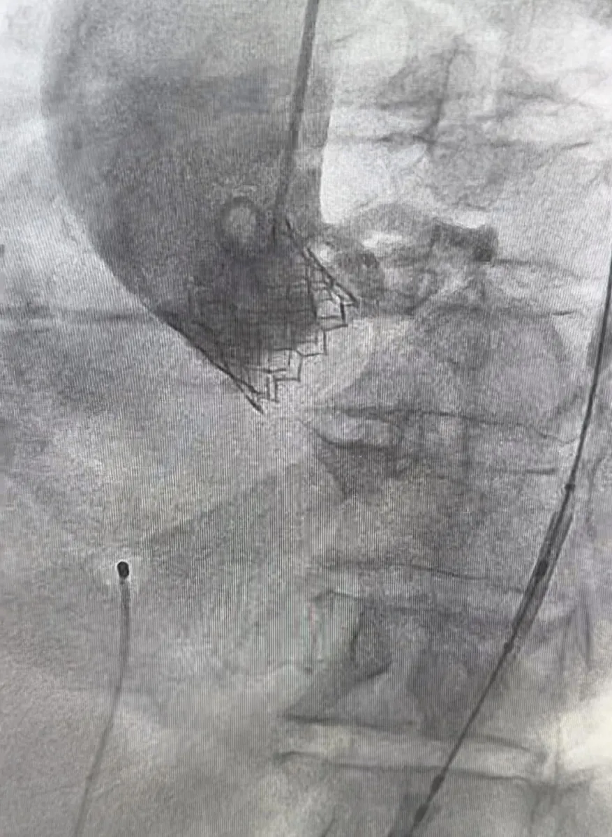 Imagen de fluoroscopia durante el implante de una válvula aórtica transcatéter